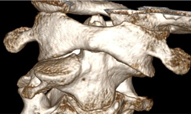 CT bilde, 3D av nakkevirvel 1 og 2